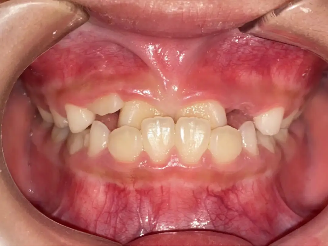 口腔DDR探针：革新口腔医学的先进技术与个性化治疗  第3张