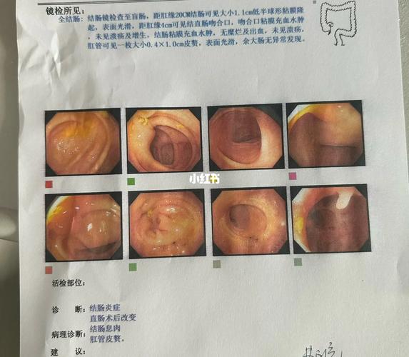 40岁后必做肠镜检查，早期发现结直肠癌，为家人负责  第4张