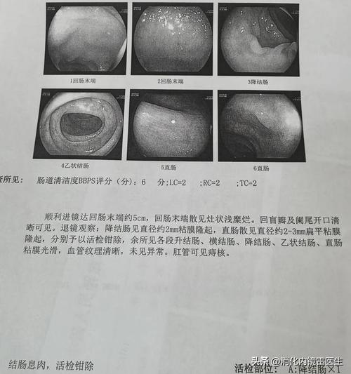 40岁后必做肠镜检查，早期发现结直肠癌，为家人负责  第5张