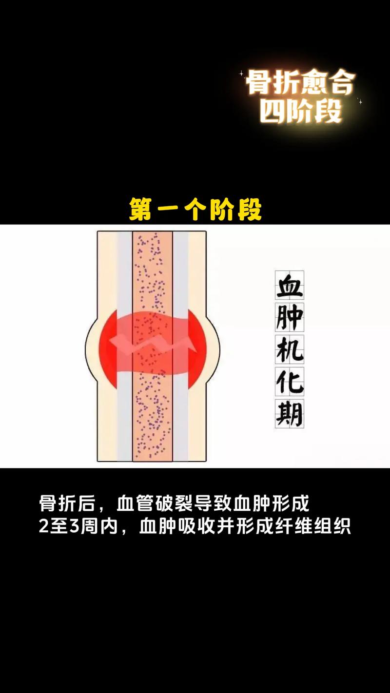 北方降雪背后的隐形杀手：骨质疏松，一摔就骨折，你真的了解吗？  第3张