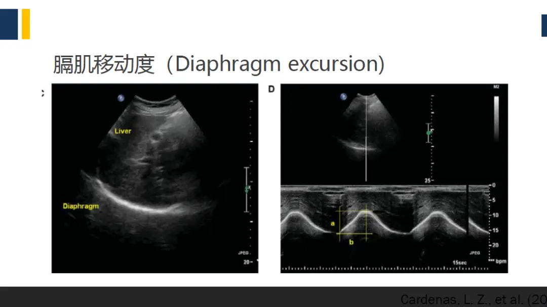腰椎DDR影像图解析与康复建议：专业医师的综合指南  第1张