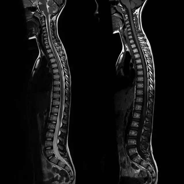 腰椎DDR影像图解析与康复建议：专业医师的综合指南  第2张
