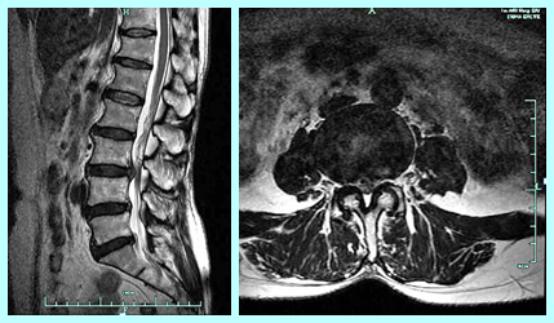 腰椎DDR影像图解析与康复建议：专业医师的综合指南  第3张