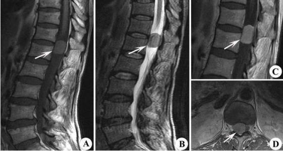 腰椎DDR影像图解析与康复建议：专业医师的综合指南  第5张
