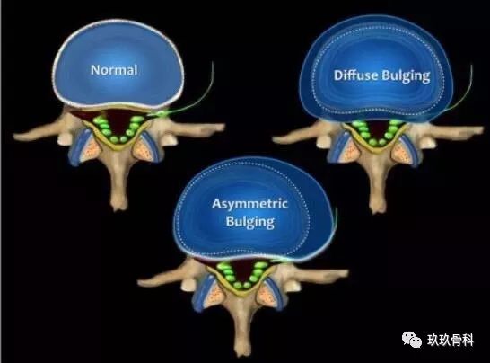 腰椎DDR影像图解析与康复建议：专业医师的综合指南  第6张