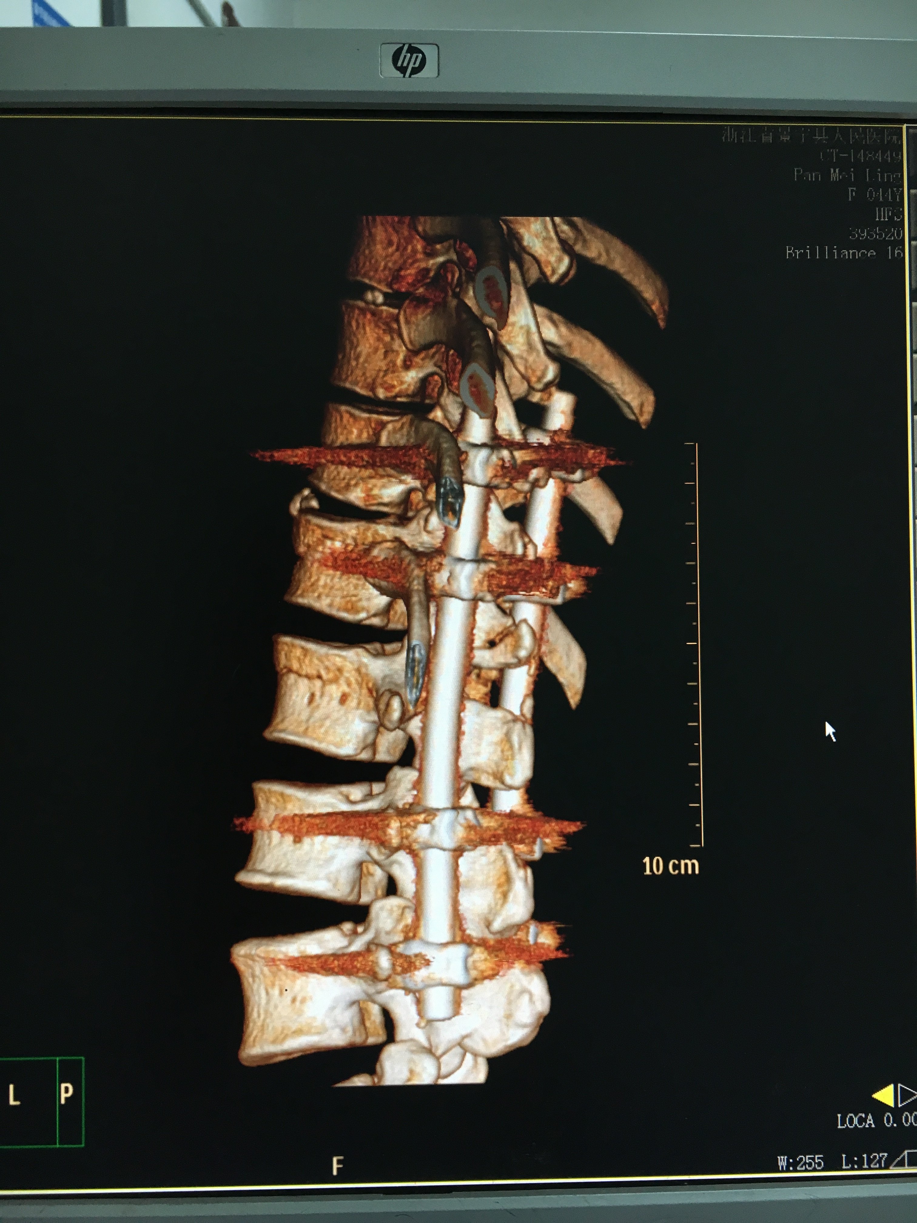 腰椎DDR影像图解析与康复建议：专业医师的综合指南  第8张