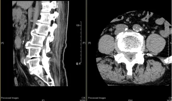 腰椎DDR影像图解析与康复建议：专业医师的综合指南  第9张