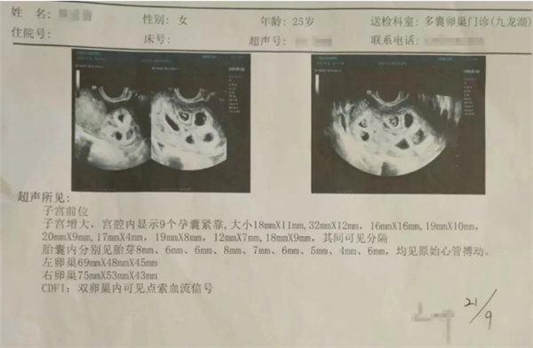 南昌 25 岁女子注射促排卵针，1 个月后竟怀上 9 胞胎  第6张