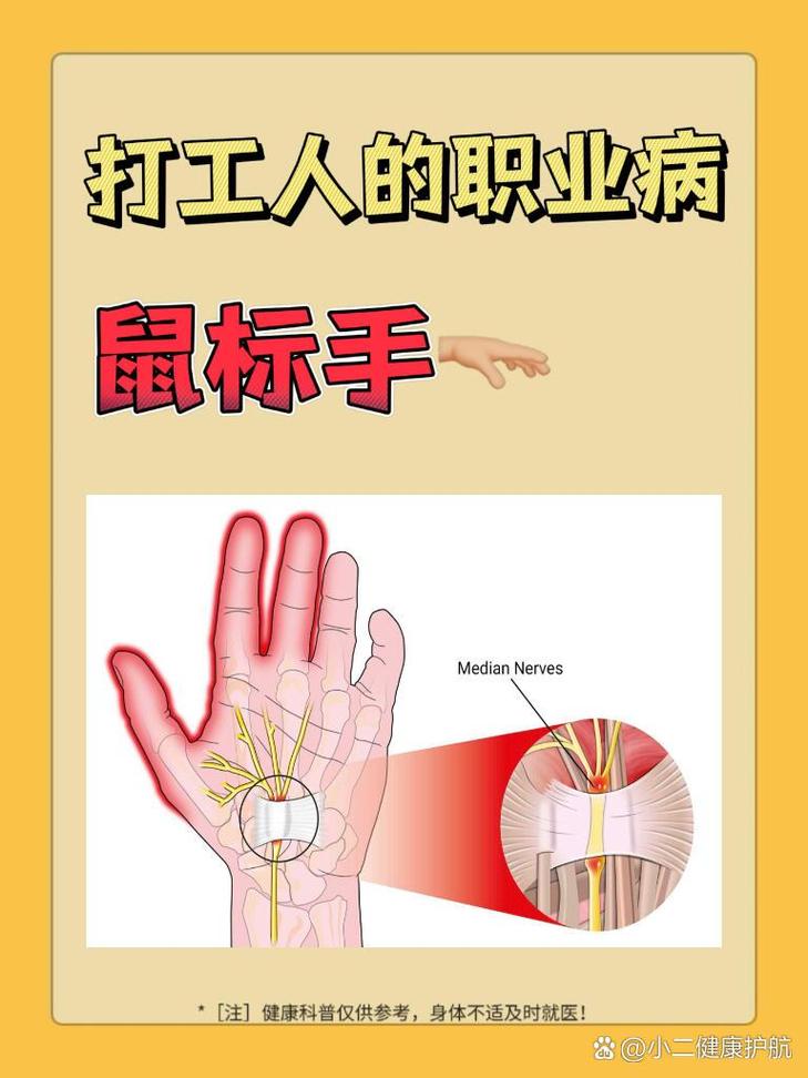 鼠标手正式被列为职业病，你还在忽视吗？  第8张