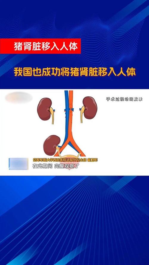 基因编辑猪肾脏第三次成功移植人体，53岁女性重获新生