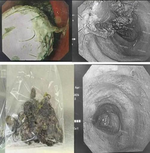 9岁女孩胃里惊现4厘米头发团，医生揭秘惊人异食癖真相