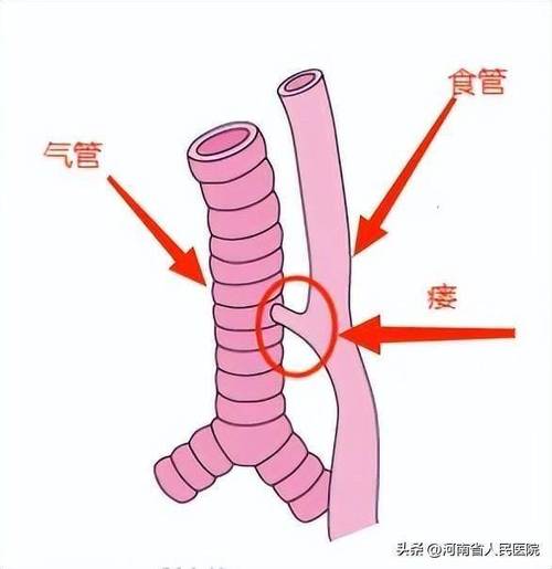 揭秘人体致命缺陷：食道与气管的致命距离，你真的了解吗？  第9张