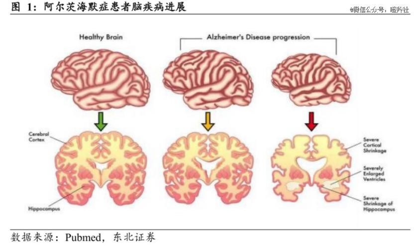 大脑细胞压力竟是阿尔茨海默症的幕后黑手，新研究揭示惊人真相  第9张