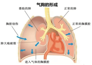 瘦高青少年为何更易‘爆肺’？揭秘气胸的致命真相