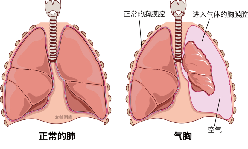 瘦高青少年为何更易‘爆肺’？揭秘气胸的致命真相  第8张