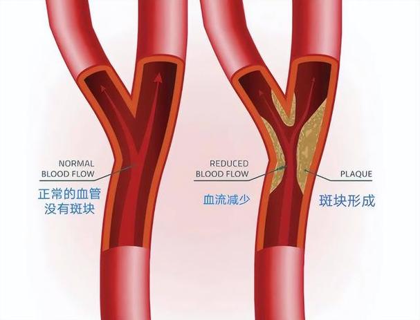 你的颈动脉里竟藏着这些隐形杀手！如何逆转？专家揭秘