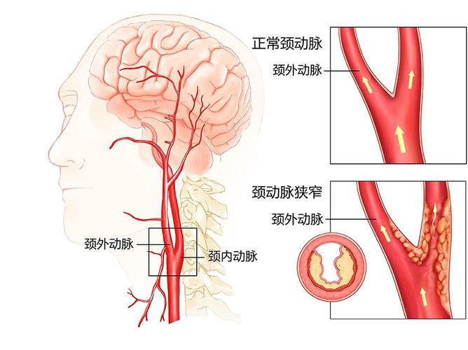 你的颈动脉里竟藏着这些隐形杀手！如何逆转？专家揭秘  第5张