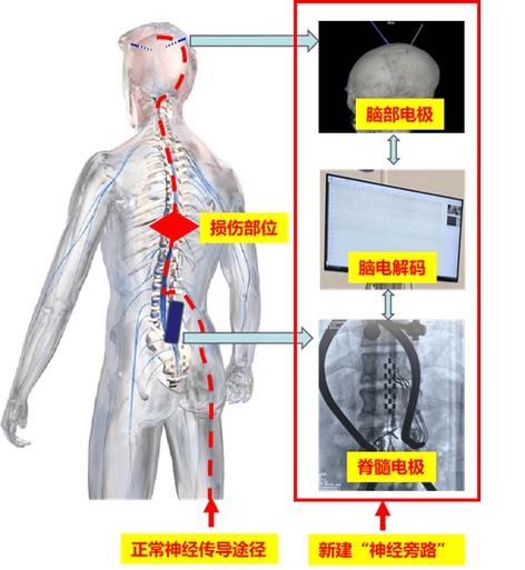 全球首例！截瘫患者重获行走能力，脑脊接口技术将如何改变千万家庭的命运？  第6张