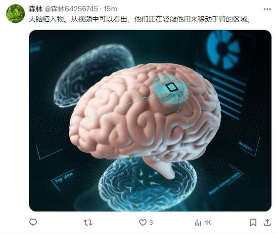 马斯克揭秘Neuralink新进展：2025年将植入20-30例患者，脑机接口技术将如何改变人类未来？  第6张