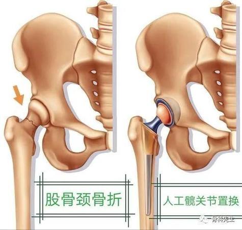 髋部骨折：为何被称为‘人生的最后一次骨折’？老年人如何避免这一致命风险？  第8张