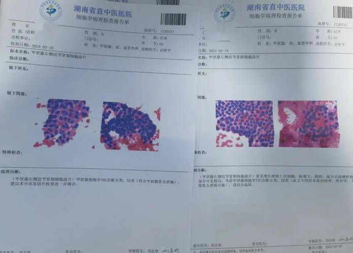 家族中一人患甲状腺癌，竟牵连全家！你还在忽视体检吗？