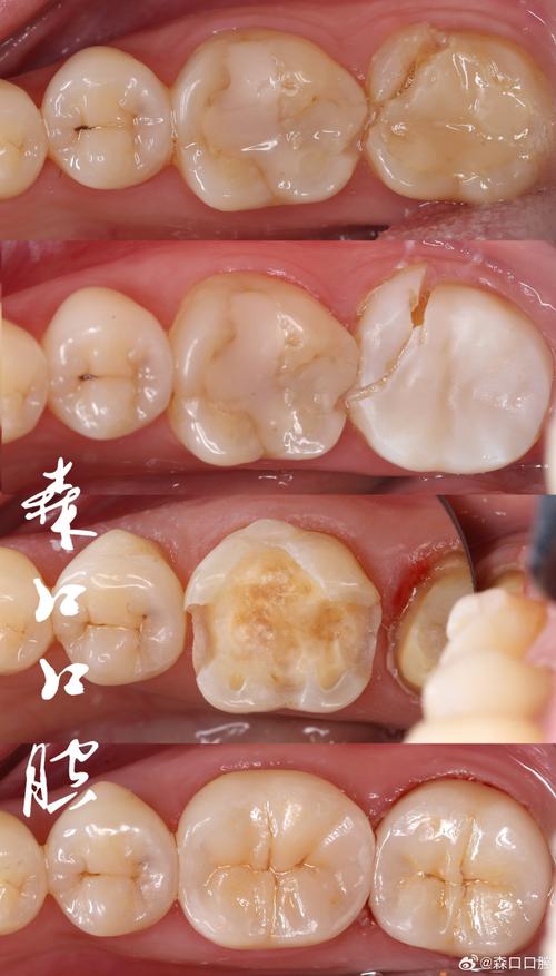 牙釉质损伤竟有这些严重后果！你的牙齿还好吗？  第5张