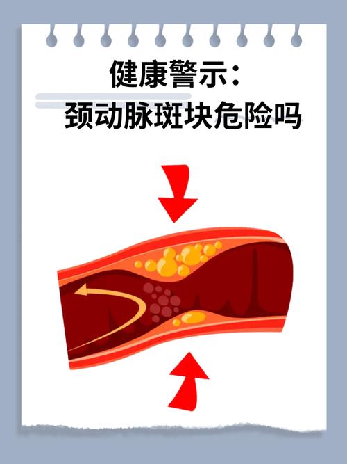 你的血管正在悄悄堆积斑块？如何预防和对抗这一隐形杀手  第2张