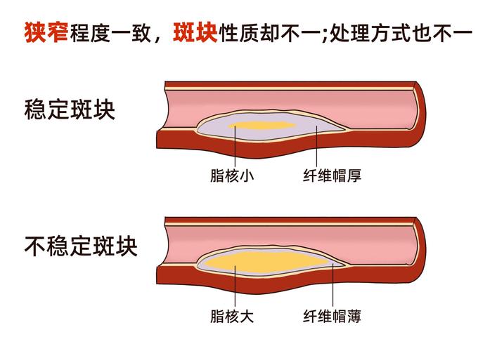 你的血管正在悄悄堆积斑块？如何预防和对抗这一隐形杀手  第3张