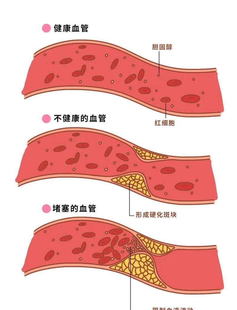 你的血管正在悄悄堆积斑块？如何预防和对抗这一隐形杀手  第6张