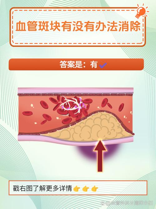 你的血管正在悄悄堆积斑块？如何预防和对抗这一隐形杀手  第7张