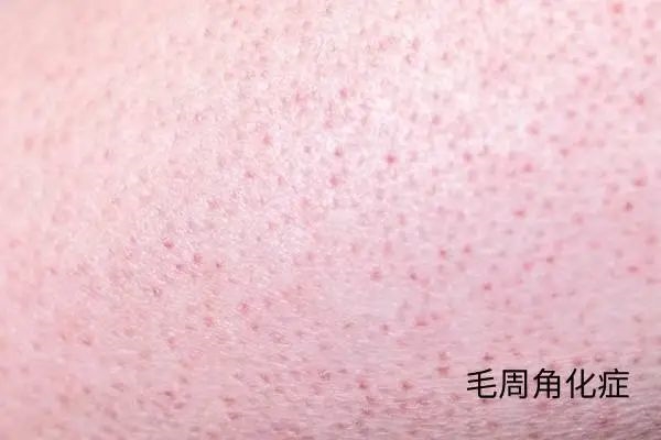 几块钱一管的淡斑美白圣品？维A酸乳膏真能当护肤品用？  第9张