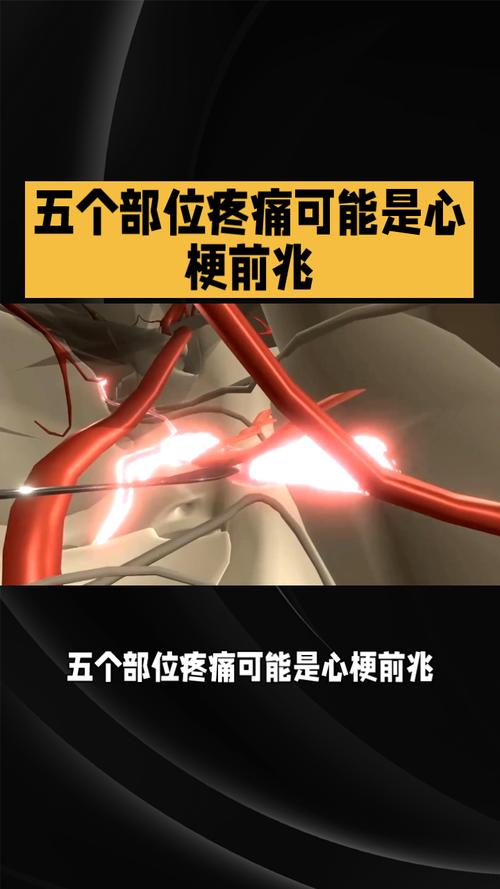 心梗前兆竟被忽视？牙疼、腹痛可能是致命信号！你留意了吗？  第6张