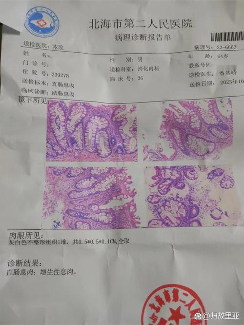 体检报告上的息肉究竟要不要紧？这种肠息肉几乎100%会癌变