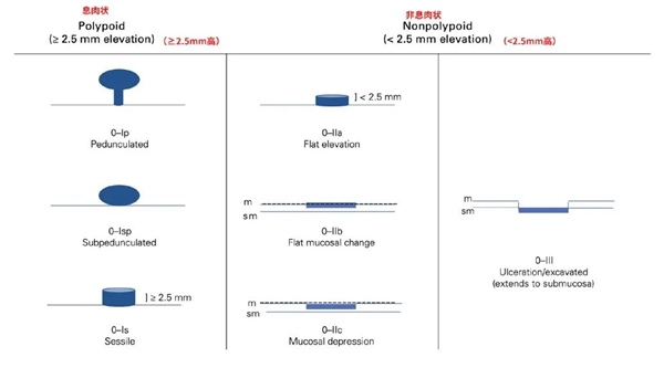 体检报告上的息肉究竟要不要紧？这种肠息肉几乎100%会癌变  第2张