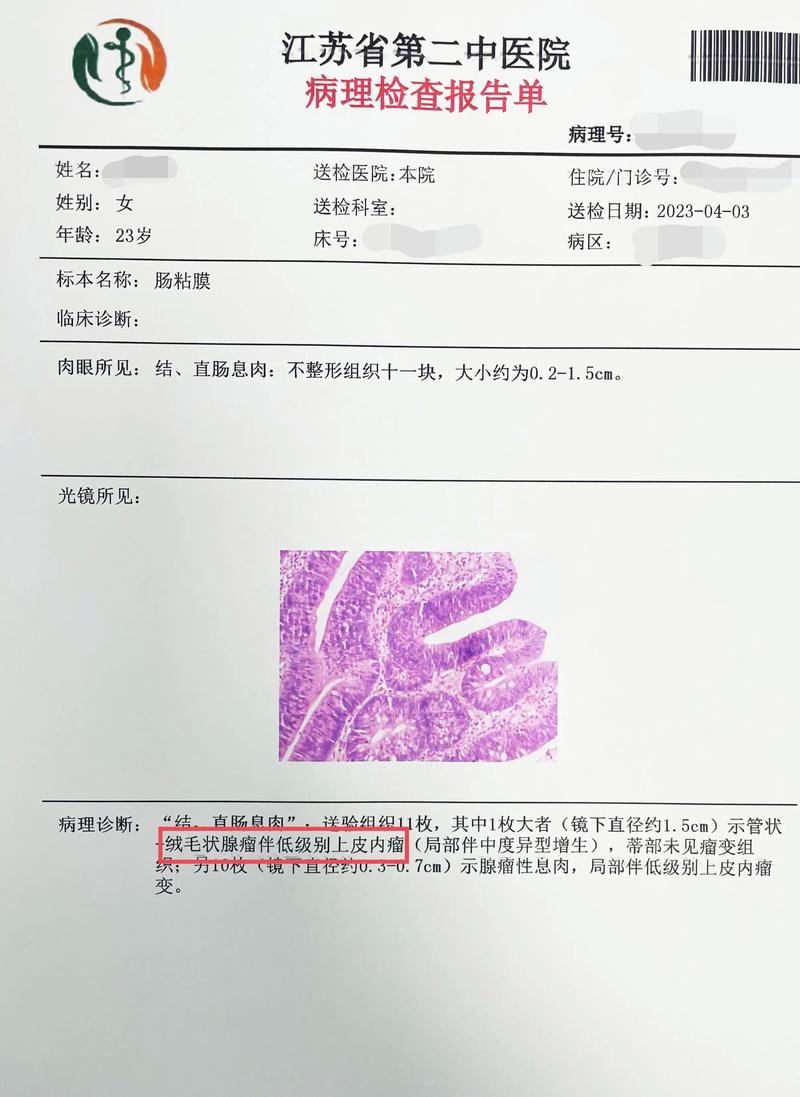 体检报告上的息肉究竟要不要紧？这种肠息肉几乎100%会癌变  第5张