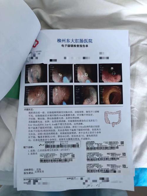 体检报告上的息肉究竟要不要紧？这种肠息肉几乎100%会癌变  第9张