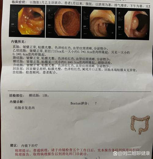 体检报告上的息肉究竟要不要紧？这种肠息肉几乎100%会癌变  第10张